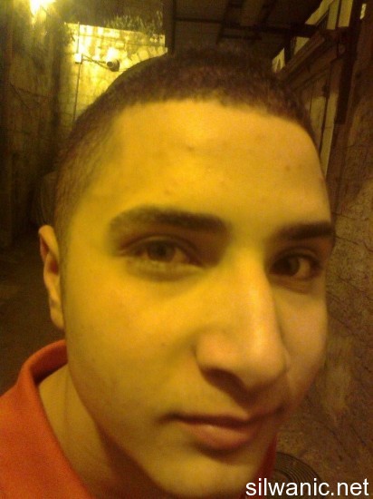 علاء زغير انتفاخ بالعين