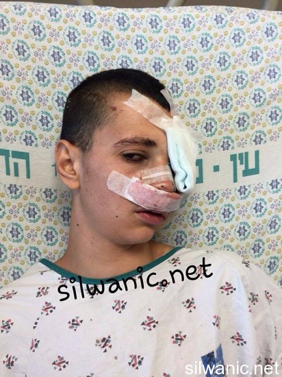 برقان اصابة