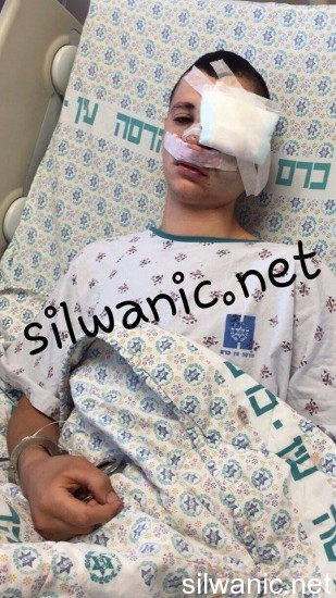 برقان عين اصابة